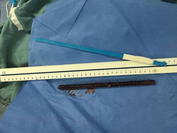 命悬一线小伙醉酒一根钢筋贯穿颅脑千钧一发浙二抢救多学科十小时奋战